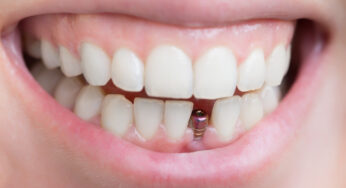 Sharjah Dental Implant, an Experience