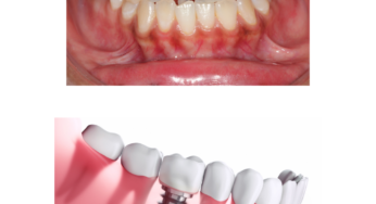 Addressing the Latest Dental Problems in the Middle East Region